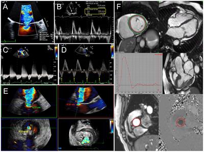 Multimodality Cardiac Imaging for Procedural Planning and Guidance of Transcatheter Mitral Valve Replacement and Mitral Paravalvular Leak Closure